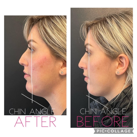 Chin and Cheek Filler