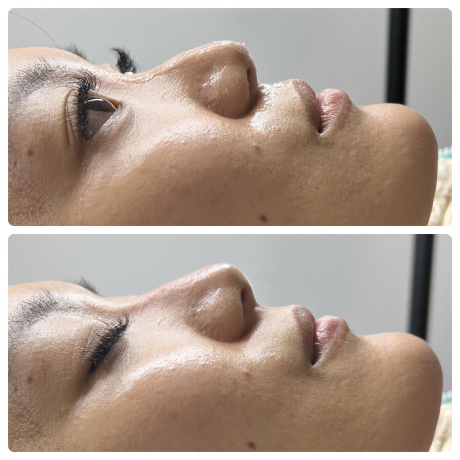 Nose Filler